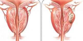 Kjo perime që vret kancerin e prostatës!