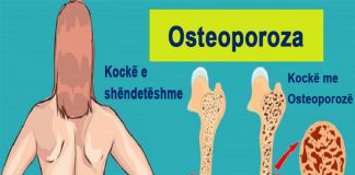 10 mënyra për të ndaluar osteoporozën dhe për të përmirësuar kockat tuaja!