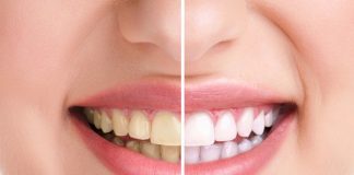 Njihuni me ushqimin më të keq që shkakton njollat në dhëmbët tuaj