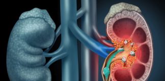 Gurët në veshka: Këto ushqime ju mbrojnë! – Çfarë të shmangemi!