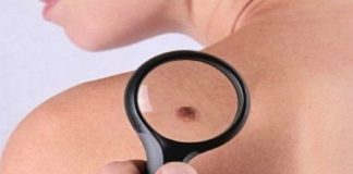 Të kruhen nishanet në lëkurën tuaj? Shih kur kruajtia është kancerogjene