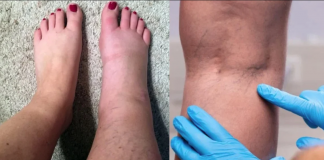 Simptoma që paralajmërojnë rrezikun e trombozës