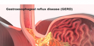 I mbrojtur: Bimët kuruese për refluksin gastroezofageal