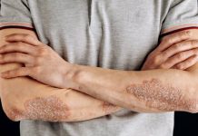 Fryerja e lekures(psoriasis) dhe presioni i lartë i gjakut – Si lidhen