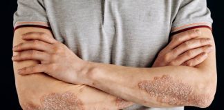 Fryerja e lekures(psoriasis) dhe presioni i lartë i gjakut – Si lidhen