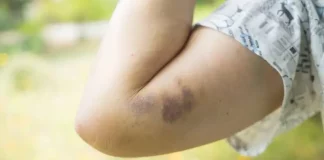 Pse mavijsohemi lehtë? 7 shkaqet e mundshme