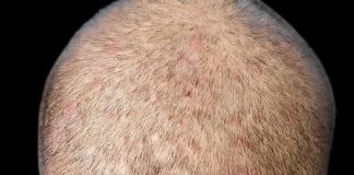 U përpoqëm të ndërronim shampon, por kjo vazhdon të shfaqet në lekurën e kokës. Çfarë është dhe çfarë tjetër ndihmon?