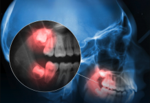 Studimet të reja tregojnë se higjena e dobët i dhëmbëve përshpejton tkurrjen e zonave të trurit kritike për kujtesën