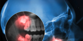 Studimet të reja tregojnë se higjena e dobët i dhëmbëve përshpejton tkurrjen e zonave të trurit kritike për kujtesën